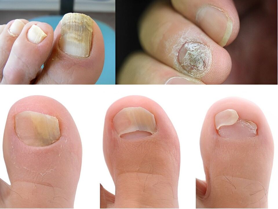 Onychomycosis stage